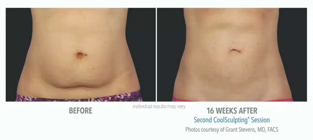 CoolSculpting Treatments In Chadds Ford, PA - Contoured Botox & Weight Loss  Med Spa