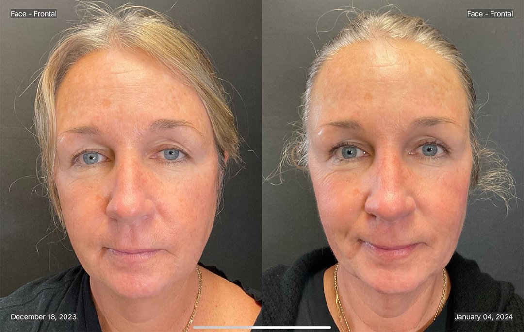 Emface - Alternatives to botox at Contoured Glen Mills