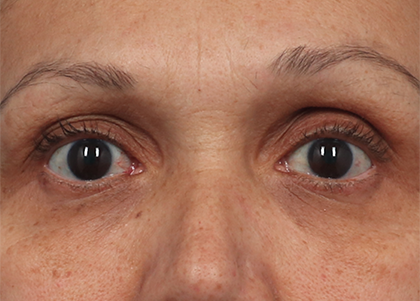 after emface eyes