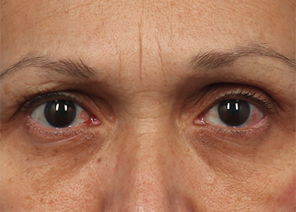 before emface eyes