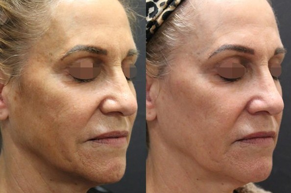 Fall for laser treatments